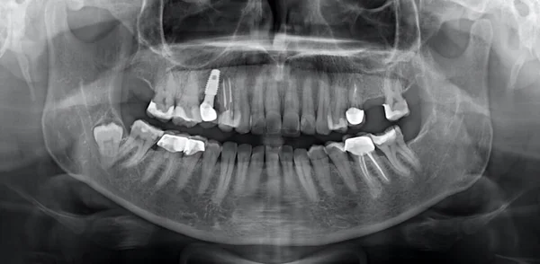 全景下巴X光片 内装牙齿 充填牙齿及智齿 — 图库照片
