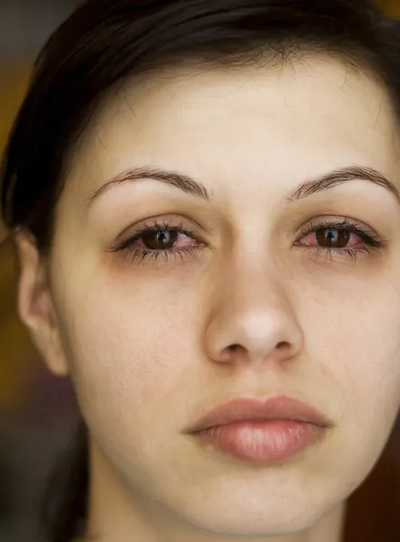 Больные глаза женщины — стоковое фото