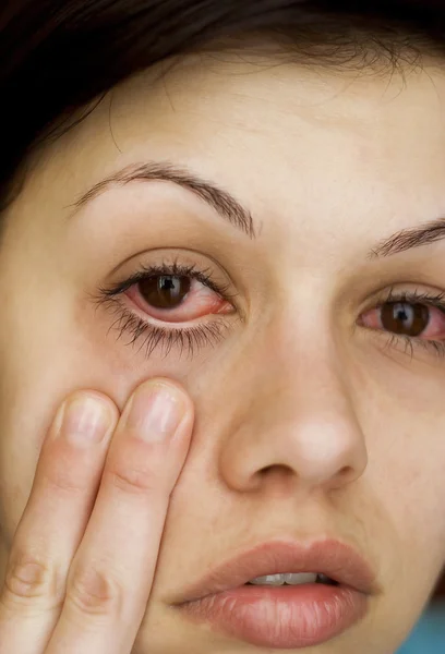 Olhos de mulher doente — Fotografia de Stock