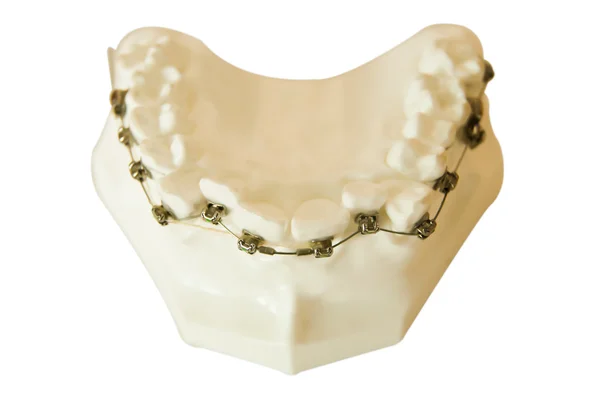 Kunstgebitten, orthodontische draad — Stockfoto