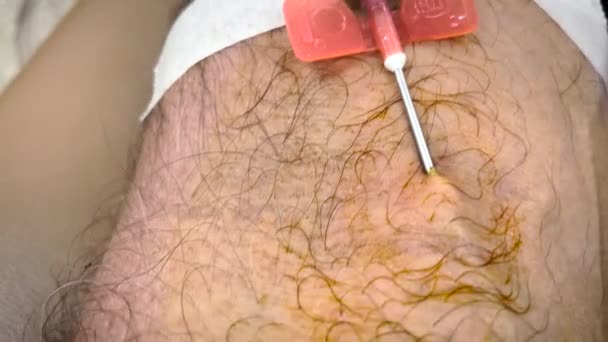 Augusta Usa Primer Plano Donante Plasma Con Aguja Inyectada Brazo — Vídeo de stock