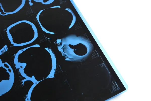 Bilgisayarlı Tomografi ve hap