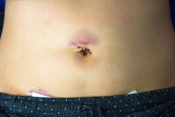 normal appendicitis scar