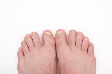 onikositoz, tırnağın mantar enfeksiyonudur. Yaralı tırnaklı bacaklar yakın planda beyaz arka planda. Ayağın mikozlarının teşhisi ve tedavisi. Korkunç ayak tırnakları..