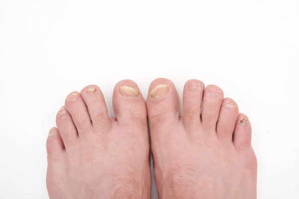 爪筋症は爪の真菌感染症です 近くの白い背景に負傷した爪を持つ足 足の筋肉の診断と治療 怖い歯の爪 ロイヤリティフリーのストック写真