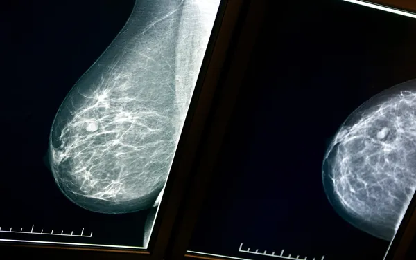 乳房的 x 射线 — 图库照片