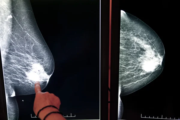 X-ray mamogram — Stock fotografie