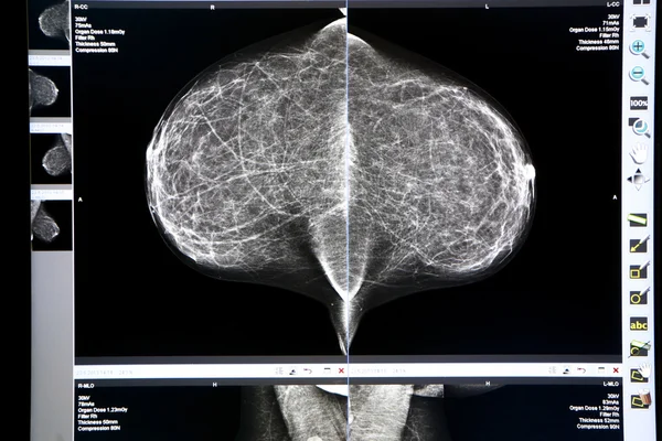 Röntgen mammogram Jogdíjmentes Stock Fotók