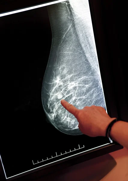 Röntgen mammogram Jogdíjmentes Stock Képek