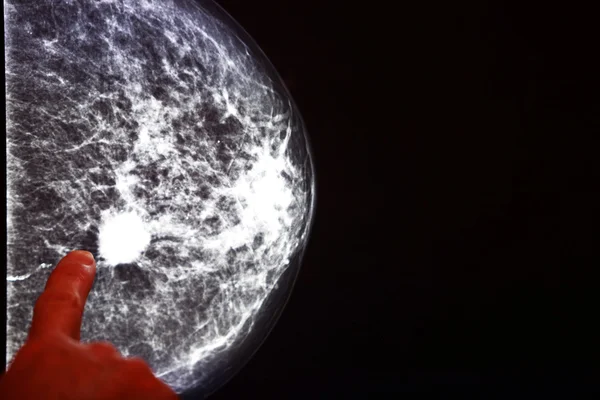 Рентгенівська мамографія Ліцензійні Стокові Зображення