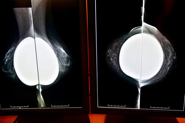 Röntgen mammogram Jogdíjmentes Stock Fotók