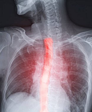 Esophagram ya da Baryum kırlangıcı görüntüsü hasta Esophageal kanser için özel stent yerleştirmesini gösteriyor.