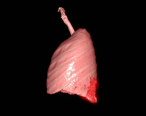 Återgivning Humana Lungor Lateral Visar Luftvägsinfektion — Stockfoto
