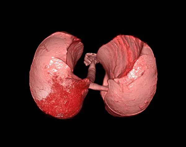 Rendering Del Polmone Umano Che Mostra Sistema Respiratorio — Foto Stock