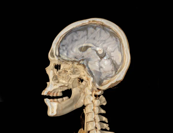 Haft Del Cranio Che Mostra Cervello — Foto Stock