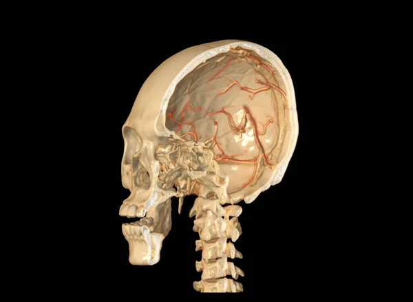 Eixo Crânio Mostrando Cérebro Dentro Crânio — Fotografia de Stock