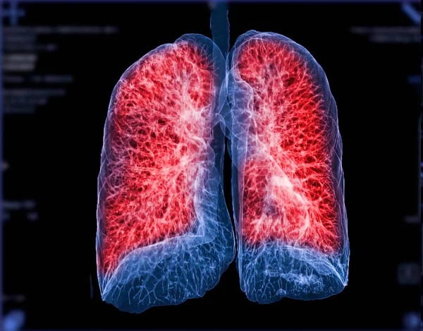 Focus Selettivo Dell Immagine Rendering Chest Lung Sul Monitor Diagnosi — Foto Stock