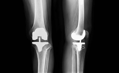 film X-ray Sol diz AP ve yan görünüm osteoartrit diz hastası ve suni eklem ile diz yenileme.