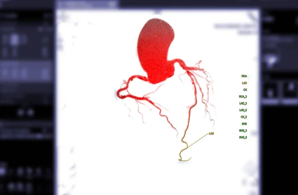 Cta Tętnica Wieńcowa Renderowania Obrazu Ekranie Celu Rozpoznania Zwężenia Tętnicy — Zdjęcie stockowe