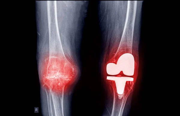 Film Ray Both Knee View Osteoarthritis Knee Patient Artificial Joint — ストック写真