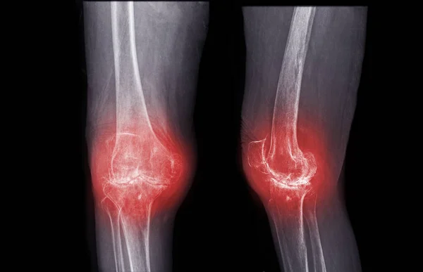 Film Ray Knee Lateral View Osteoarthritis Knee Patient Artificial Joint — Foto Stock