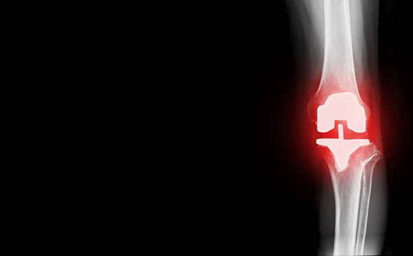 Film Ray Knee View Osteoarthritis Knee Patient Artificial Joint Knee — Foto Stock