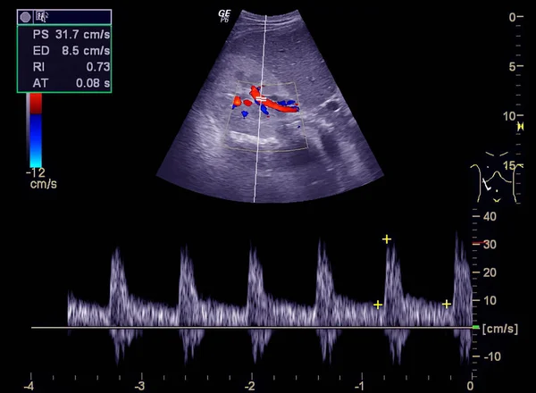 Ultrazvuk Horní Části Břicha Ukazující Průtok Běžném Žlučovodu Použití Barva — Stock fotografie