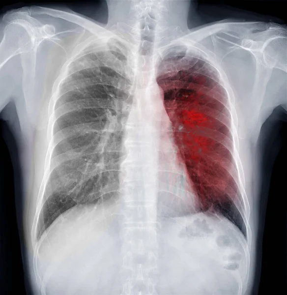 Radiografie Toracică Pieptului Uman Sau Plămânului Pentru Detectarea Tuberculozei — Fotografie, imagine de stoc