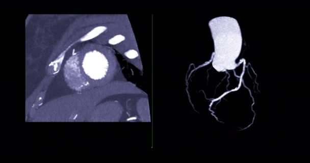 Cta Coronary Artery Rendering Turn Screen Diagnosis Vessel Coronary Artery — Stock video