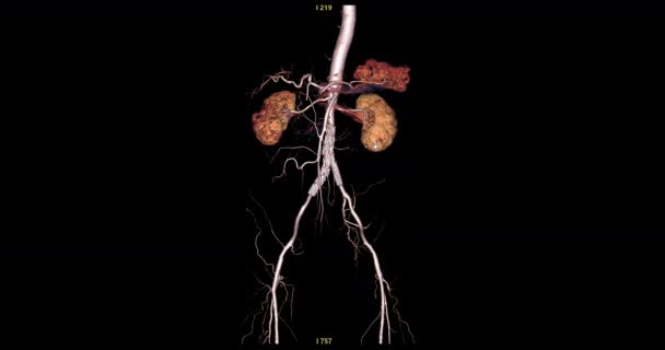 Cta Břišní Aorta Vykreslování Otočení Obrazovce Pro Diagnózu Aortální Disekce — Stock video