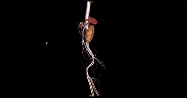 Cta Abdominal Aorta Rendering Turn Screen Diagnosis Aortic Dissection Aneurysm — Wideo stockowe