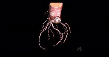 CTA koroner arter 3D döndürme damar koroner arter hastalığı teşhisi için ekranda geri dönün .