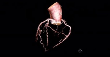 CTA koroner arter 3D döndürme damar koroner arter hastalığı teşhisi için ekranda geri dönün .