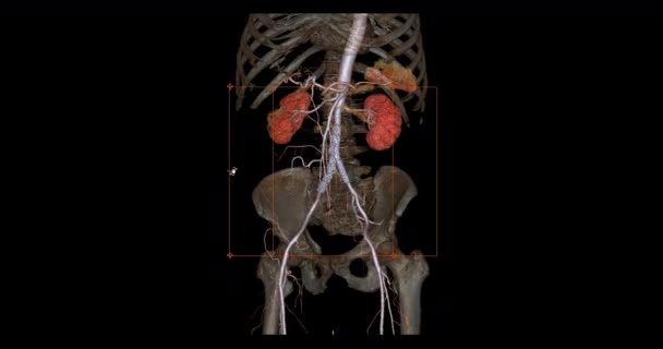 Cta Abdominal Aorta Rendering Turn Screen Diagnosis Aortic Dissection Aneurysm — Wideo stockowe