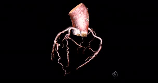 Cta Coronary Artery Rendering Turn Screen Diagnosis Vessel Coronary Artery — Vídeo de Stock