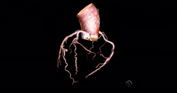 Cta Coronaire Slagader Rendering Draai Rond Het Scherm Voor Diagnose — Stockvideo