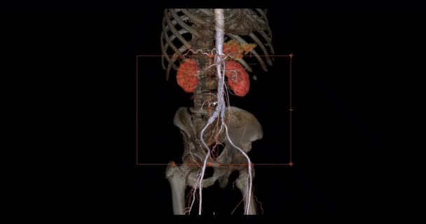 Cta Abdominal Aorta Rendering Turn Screen Diagnosis Aortic Dissection Aneurysm — Stockvideo