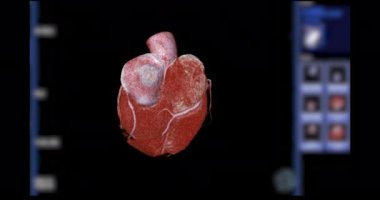 CTA koroner arter 3D döndürme damar koroner arter hastalığı teşhisi için ekranda geri dönün .