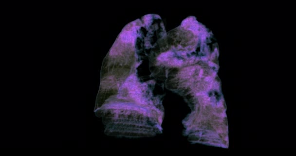 結核診断のためのCt胸部または肺3Dレンダリング画像Tb 結核とCovid — ストック動画