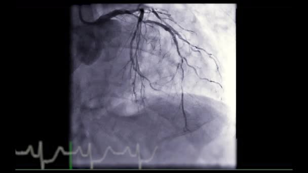 心臓カテーテル法は 心停止を調べるために用いられる検査である — ストック動画
