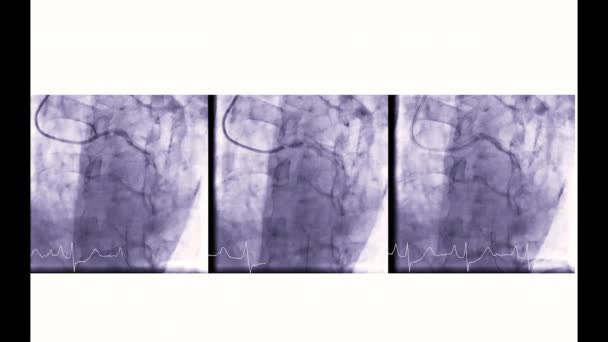 Cateterismo Cardíaco Teste Usado Para Descobrir Parada Cardíaca — Vídeo de Stock