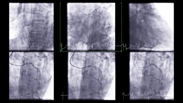 Cardiac Catheterization Test Used Find Out Cardiac Arrest — Video