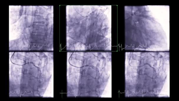 Cardiac Catheterization Test Used Find Out Cardiac Arrest — Wideo stockowe
