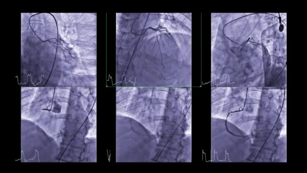 Cardiac Catheterization Test Used Find Out Cardiac Arrest — Wideo stockowe