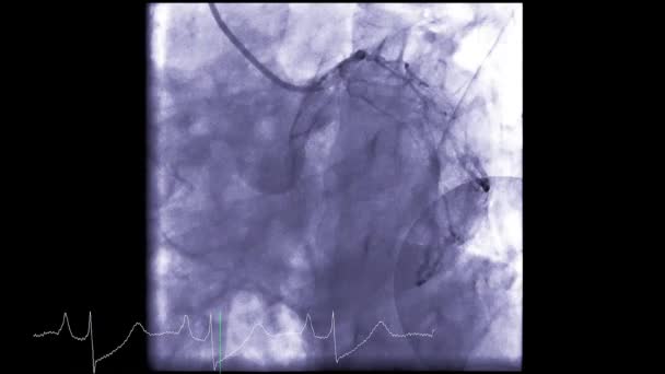 心导管插管是一种检测心脏骤停的方法 — 图库视频影像