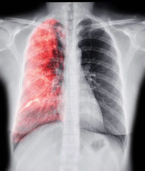 Chest Ray Lung Rendering Image Diagnosis Tuberculosis Covid — Stock Photo, Image