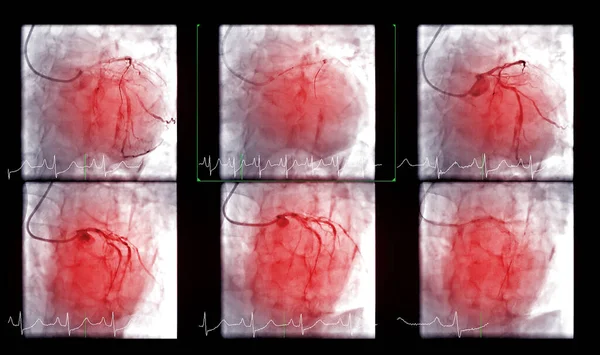 Cardiac Catheterization Test Used Find Out Cardiac Arrest — Foto de Stock