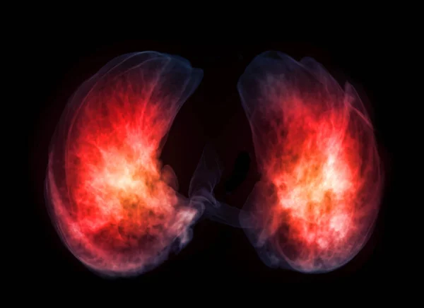 Base Lung Rendering Image Diagnosis Tuberculosis Covid Scanner — Stock Fotó