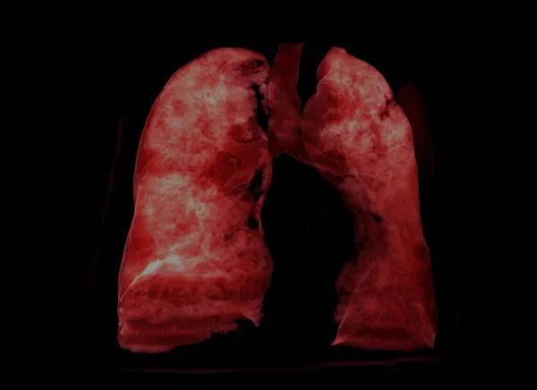 Lung Rendering Image Diagnosis Tuberculosis Covid Scanner — Foto Stock