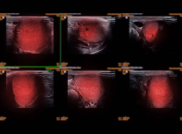 Ultrasonography of thyroid gland for diagnostics of the thyroid gland.